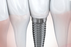 implant-dentaire