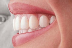gouttiere-invisalign-